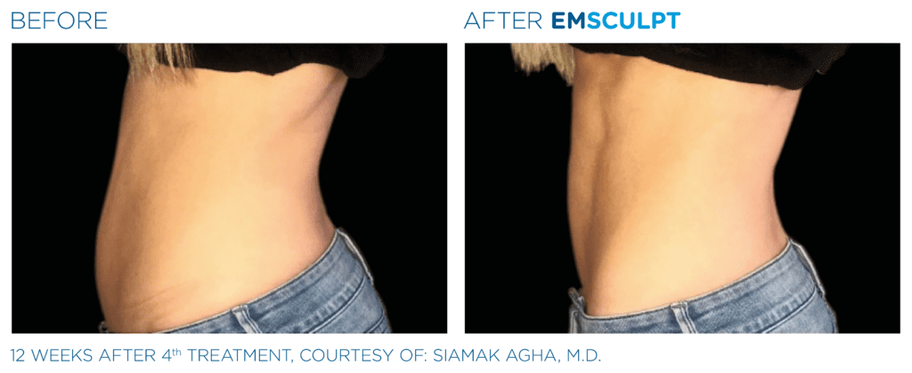 Emsculpt Body Contouring Atlanta, GA