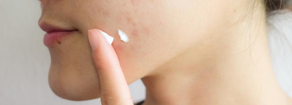 A woman applying cream to the acne on side of her face