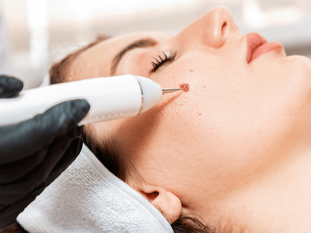 woman receiving a mole treatment