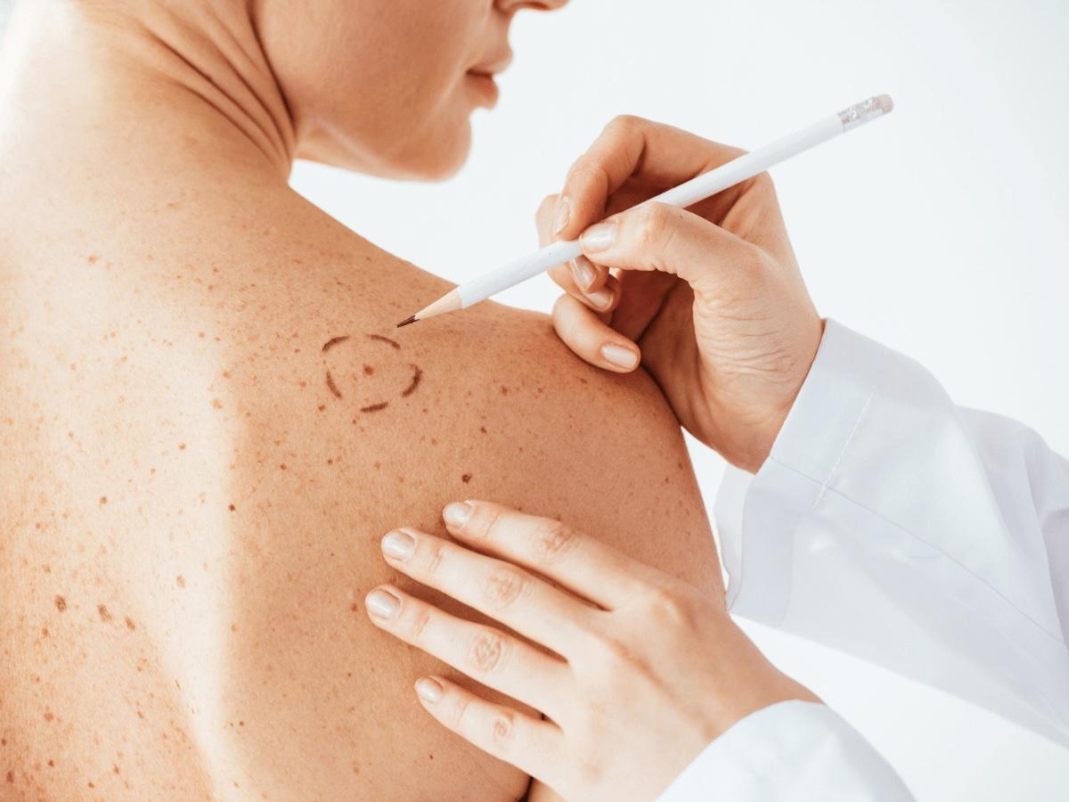 doctor outlining margins of mole on patients back